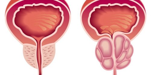 Does viagra cause prostate cancer
