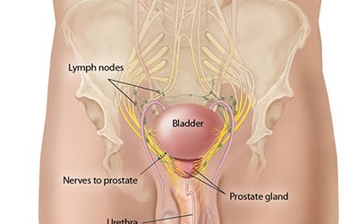 Viagra (Sildenafil) Efficacy in Post-Surgery Prostate Patients