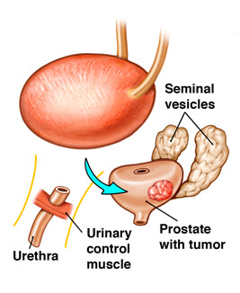 What are some radical prostatectomy side effects?