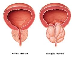 Benign prostatic hyperplasia