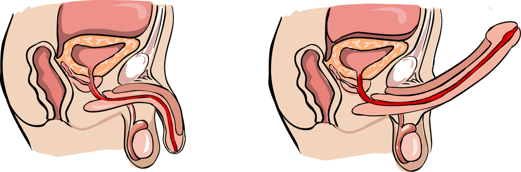 Benign prostatic hyperplasia